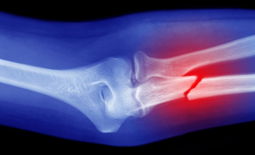 broken bone